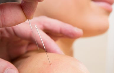 Chiropractic Killeen TX Acupuncture